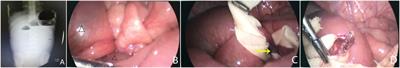 Diagnosis and surgical management strategy for pediatric small bowel obstruction: Experience from a single medical center